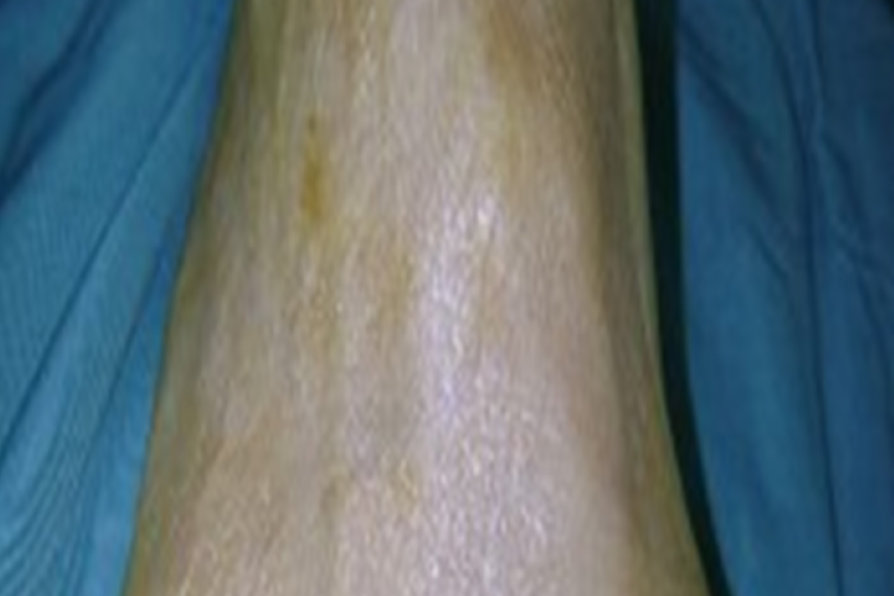 Scopri di più sull'articolo Trattamento del II dito a griffe